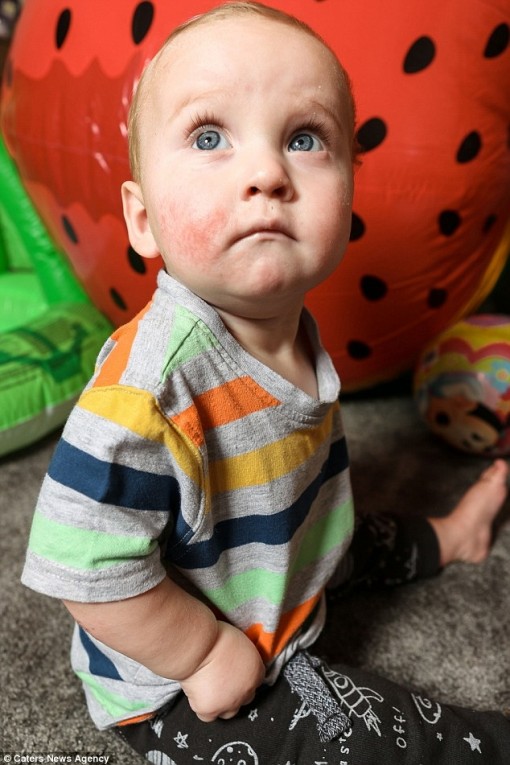 Mắc 50 loại dị ứng, bé trai chỉ ăn được 4 loại thực phẩm