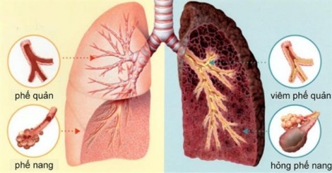Cách phát hiện ung thư phổi sớm