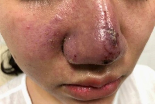 Người phụ nữ trẻ méo mặt, lệch má vì tiêm filler làm đẹp