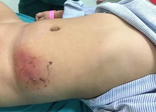 Bé 2 tuổi nguy kịch vì dán cao trị mụn