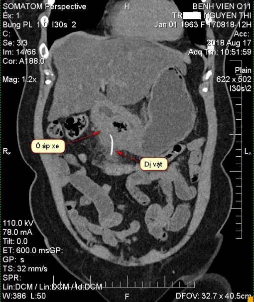 Người phụ nữ suýt tử vong vì xương cá mưng mủ trong dạ dày