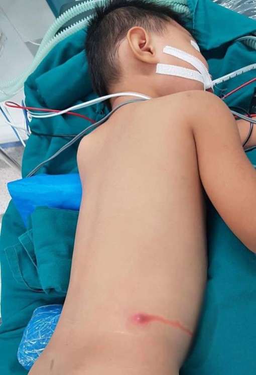 Bé trai 5 tuổi bị đạn súng hơi găm vào cột sống