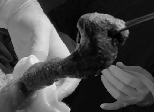 Bé gái 6 tuổi ăn tóc đến tắc ruột