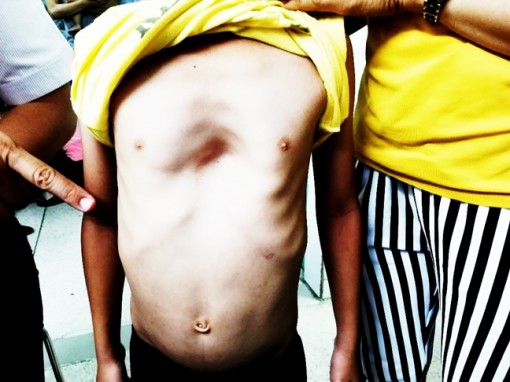 4 giờ giải quyết nang dị dạng chiếm gần hết phổi bé trai