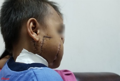 Bác sĩ sốc với bé trai bị cánh quạt công nghiệp chém nát mặt