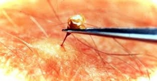 Bị ong chích có nên nặn ngòi?