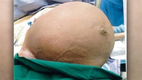 Phẫu thuật thành công khối u tử cung nặng 28kg