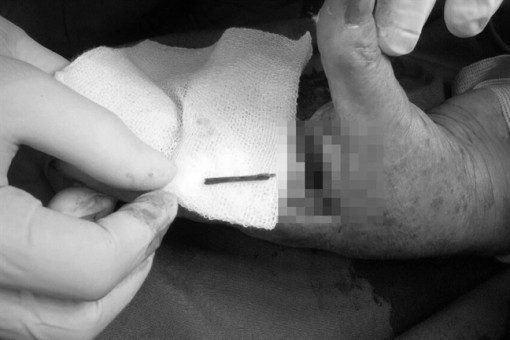 Cọng tàu lá dừa chui kẽ tay 3 năm 'hành hạ' người phụ nữ