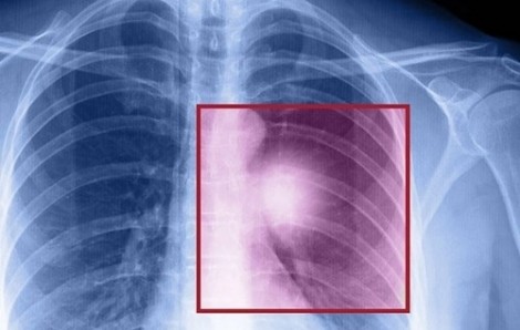 Tưởng ho thông thường, phát hiện khối u 'ăn' cả phổi