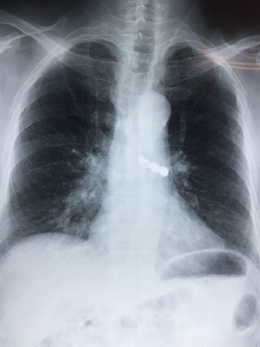 4 chiếc răng giả rơi vào phế quản cụ ông 90 tuổi