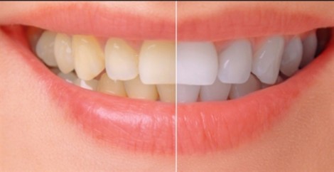 Vì sao thuốc kháng sinh gây vàng răng?