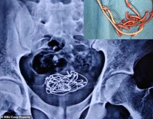 Bí tiểu vì tự nhét dây điện vào... niệu đạo