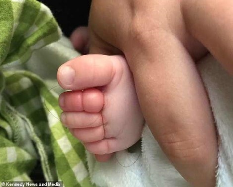 Bé sơ sinh suýt mất bốn ngón chân vì một sợi tóc