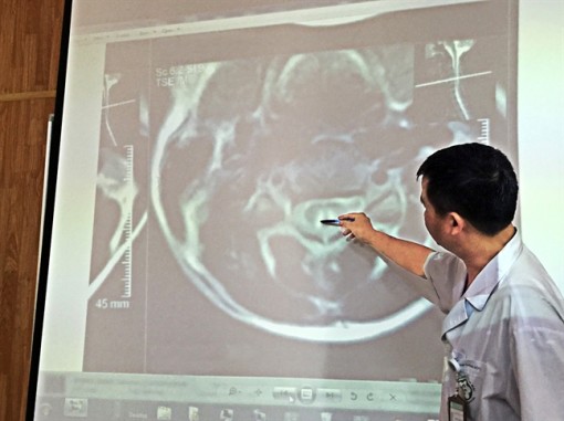 Tổn thương cột sống, liệt chi vì bóng cười