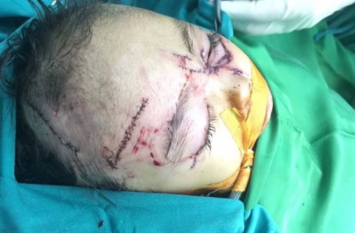 Hai cháu bé 2 tuổi bị chó nhà cắn nát mặt