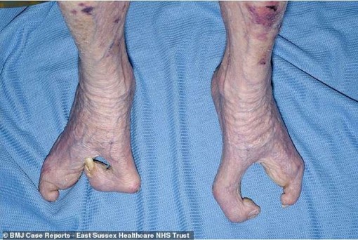 Cụ bà 94 tuổi nuôi con và đan len dù bàn tay chỉ có 3 ngón