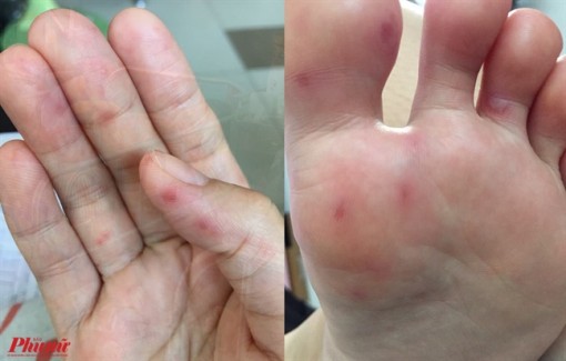 Người lớn bị tay chân miệng có phải nhập viện?