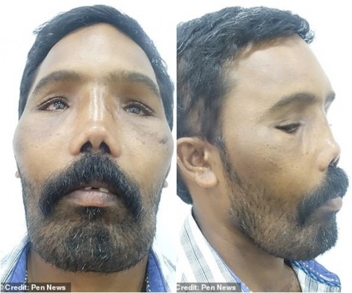 Mổ bỏ xương gò má để 'thoát' kiếp gương mặt sư tử