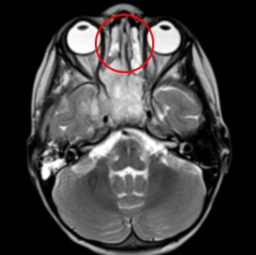 Bé gái bị chảy nước mũi, nhiễm trùng mắt, bác sĩ chẩn đoán ung thư mũi