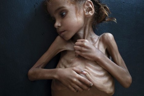 Bé gái Yemen khiến cả thế giới phải bàng hoàng vì nạn đói