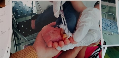Phạt cơ sở mầm non làm bé 18 tháng tuổi bị bỏng