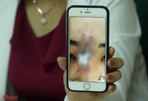 Nữ sinh viên hoại tử mũi khi tiêm chất làm đầy tại chung cư