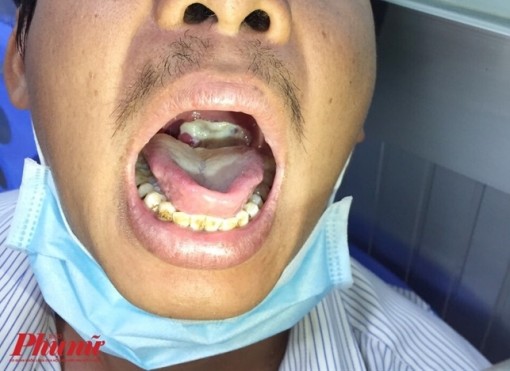 Bệnh viện Bệnh Nhiệt đới TP.HCM tiếp nhận ca bạch hầu đầu tiên trong năm