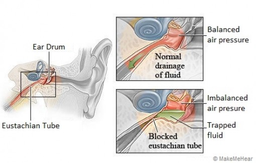 Vì sao viêm tai giữa do bệnh sởi gây ra?