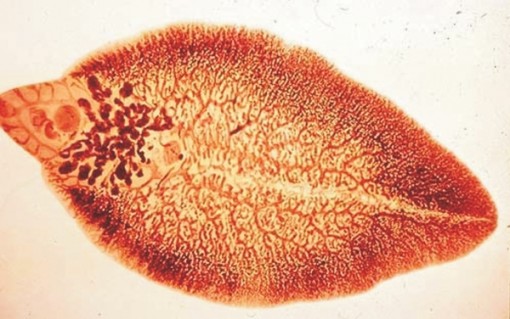 Tưởng viêm tuyến vú, nữ bệnh nhân tá hỏa phát hiện sán ngoe nguẩy bên trong