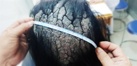 Cô gái 26 tuổi ở Đắk Lắk mắc bệnh hiếm gặp có da đầu xù xì như thân cây