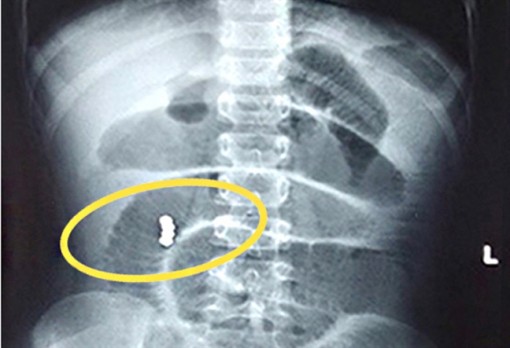 Bé gái thủng ruột do nuốt bi nam châm từ quà sinh nhật