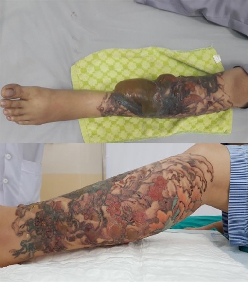 Bệnh nhân phỏng nặng sau khi thẩm mỹ viện xóa xăm bằng laser