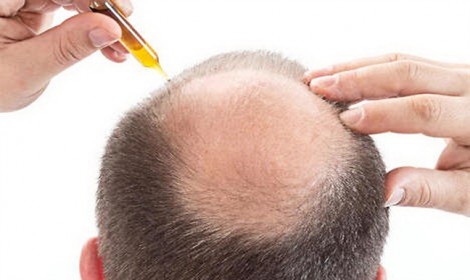 Da đầu tróc lở vì dùng thảo dược trị rụng tóc