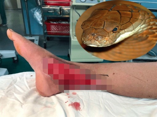 Rắn độc cắn nát chân bà cụ, bác sĩ phải dùng kỹ thuật cao để che vết thương