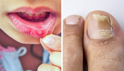 10 tác dụng phụ của thuốc kháng sinh bác sĩ không bao giờ nói ra