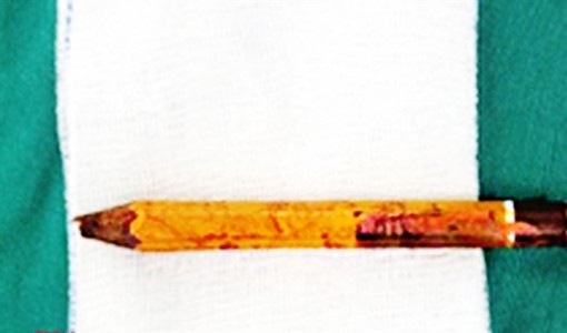 Bé trai bị bút chì đâm xuyên mông 8cm vì bạn học nghịch dại đặt dưới ghế