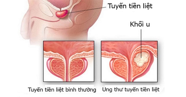 Viem ruot co lien quan den ung thu tuyen tien liet