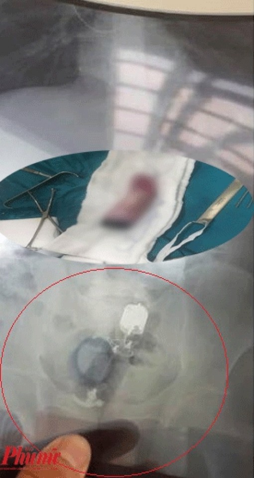 Lấy dương vật giả lọt vào bụng bệnh nhân ở Biên Hòa lúc 3 giờ sáng