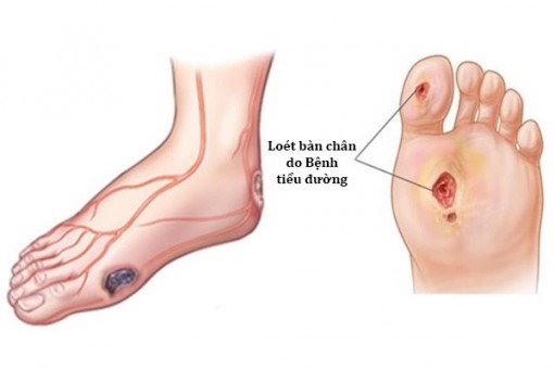 Bác sĩ Chợ Rẫy khuyến cáo sự nguy hiểm của căn bệnh khiến NSND Anh Tú qua đời