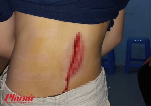 Chui rào đi chơi game, bé trai 7 tuổi bị kẽm gai xé rách lưng