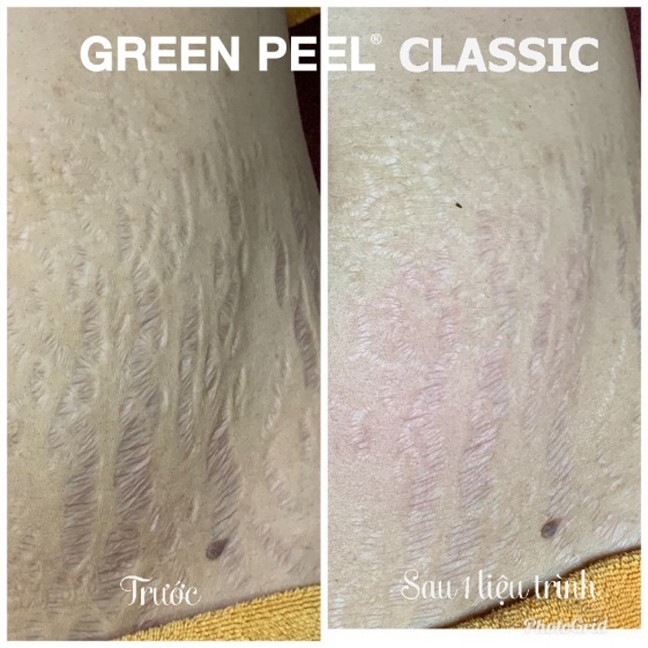 GREEN PEEL® ‘thay da’ 100% thao moc