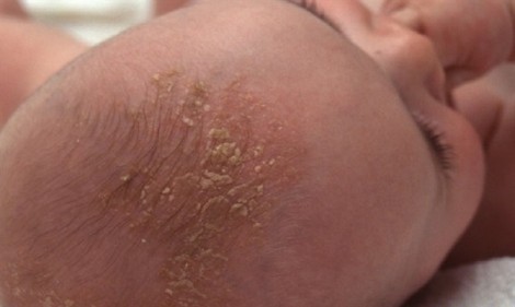 Trẻ 20 tháng tuổi xuất hiện 'cứt trâu' trên da đầu là bệnh gì?
