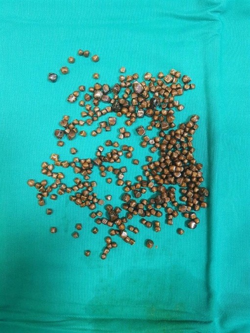 Gần 400 viên sỏi lấp đầy túi mật của bệnh nhân