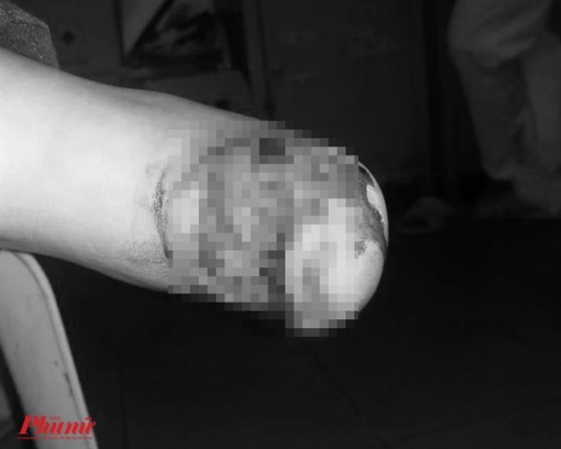 Căm xe máy khiến bé gái lên bàn mổ nối gân