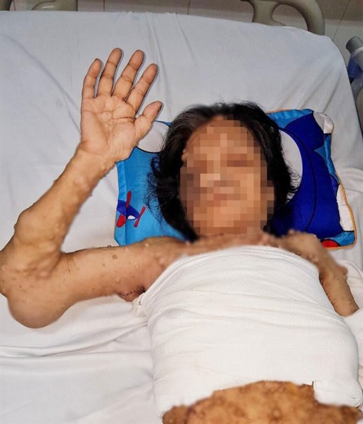 Người phụ nữ mắc hàng trăm khối u khiến cánh tay như 'đại bàng gãy cánh'