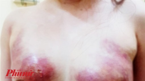 Tranh thủ làm đẹp cuối năm, 2 phụ nữ phải nhập viện để cắt bỏ phần ngực bị hoại tử