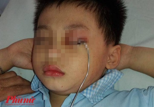 Móc cửa đứt dây cài chặt vào mí mắt bé trai