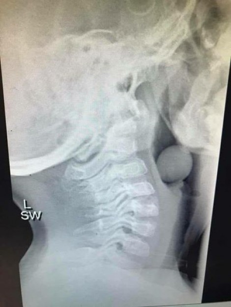 Một bác sĩ chia sẻ ảnh X-Quang con trai ngạt thở vì nuốt quả nho
