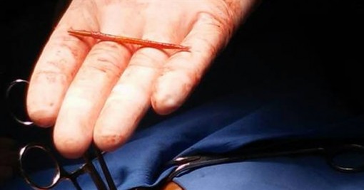 Tăm xỉa răng gây lủng gan một phụ nữ