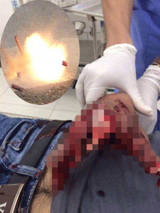 Kinh hoàng bàn tay dập nát do pháo nổ